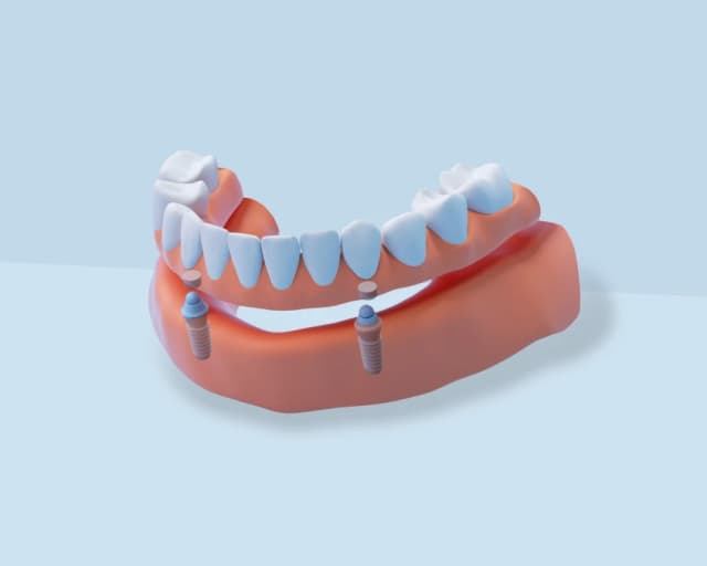 Implant supported dentures