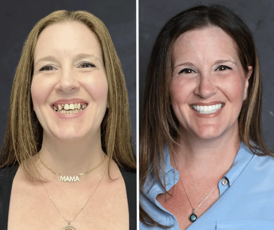 Before and after dental implant transformation of Elizabeth Tran