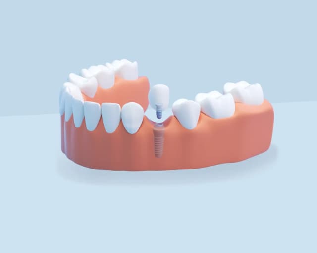 Single/multiple dental implants