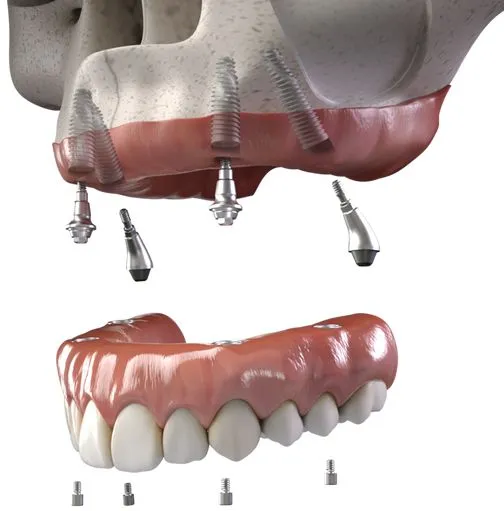 Zygomatic Dental Implant Excellence