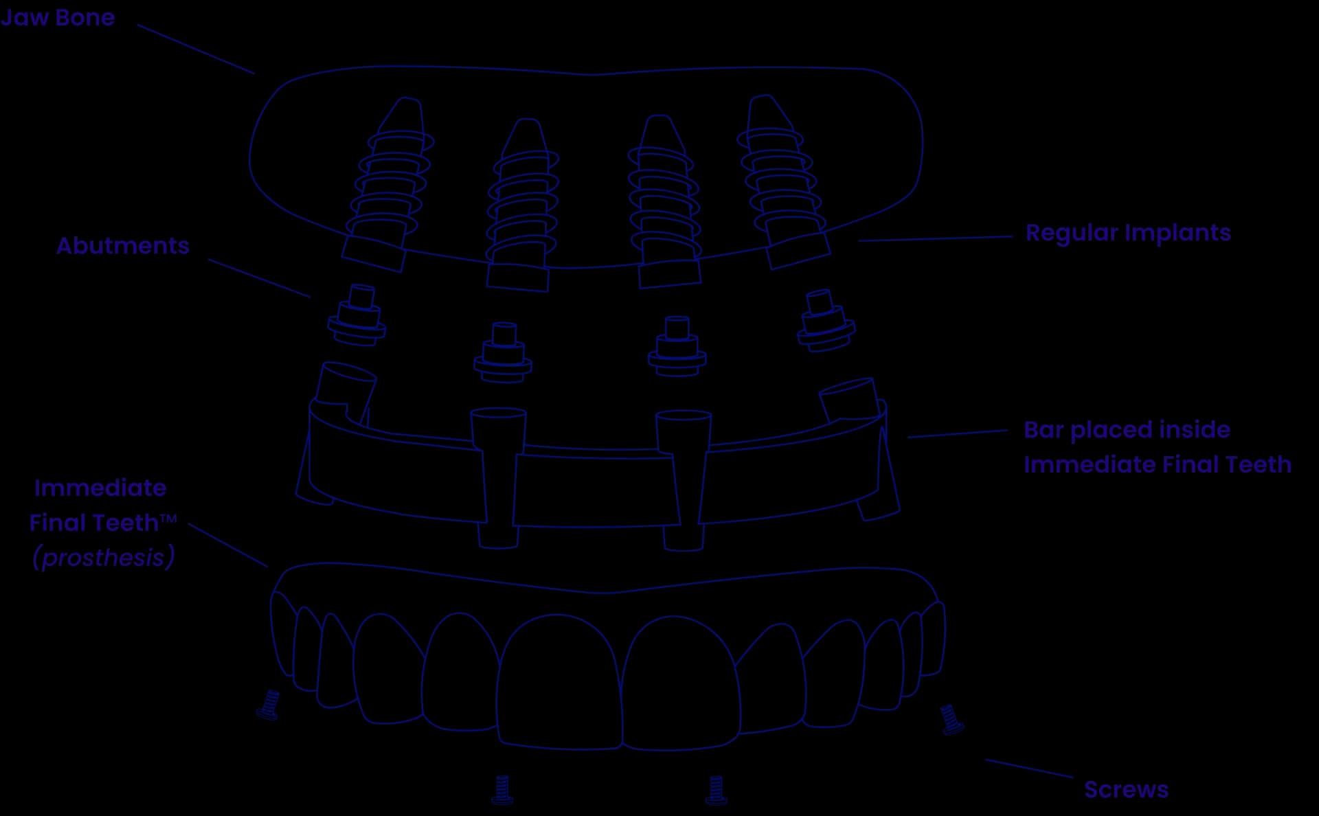 Components of All-on-8 Robust Full Mouth Dental Implants