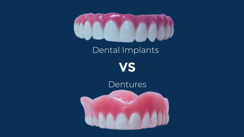 Dental Implants vs Dentures: What's Best for Long-Term Health?