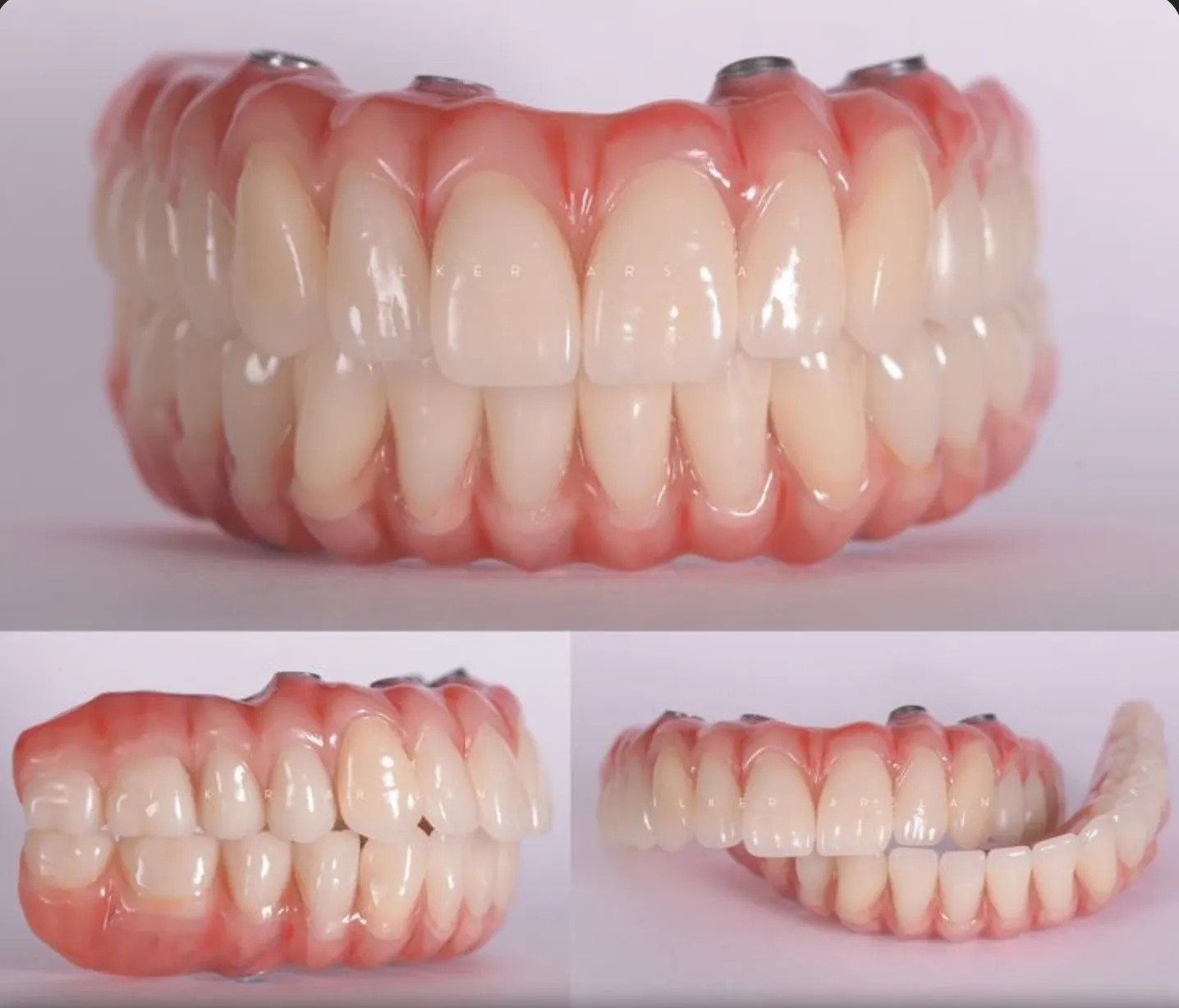 Doctor and patient reviewing dental implant options together