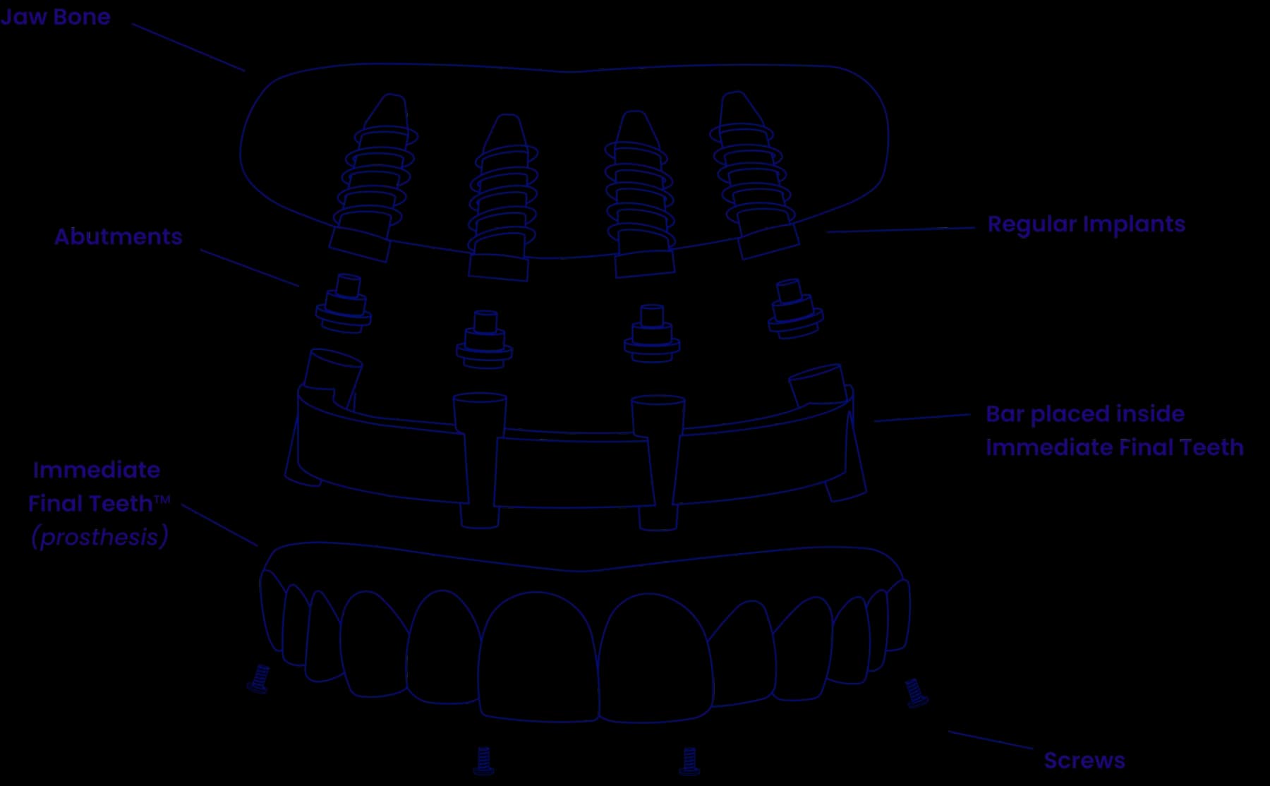 Components of the All-on-8 Robust full mouth dental implant system