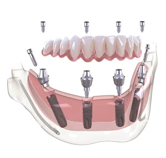 Full arch All-on-4 dental implant bridge diagram for permanent full mouth tooth replacement at Center for Implant Dentistry