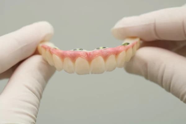 All-on-4 Full Mouth Implants zirconia bridge