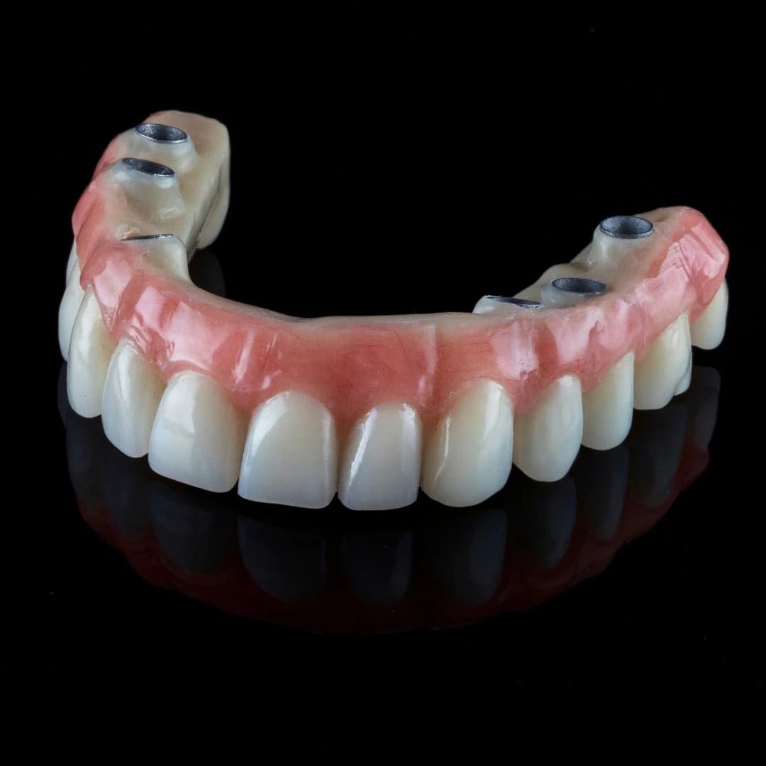 All-on-6 Full Mouth Implants zirconia bridge