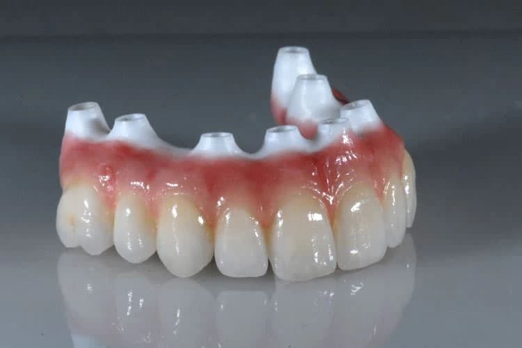 All-on-8 Robust Full Mouth Implants zirconia bridge