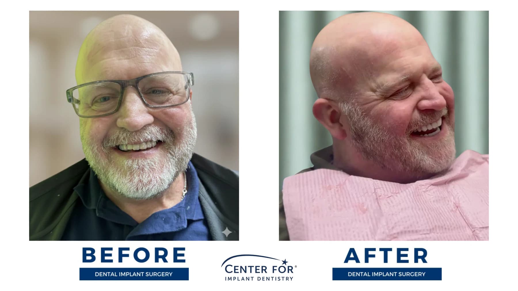 Full-arch dental implant smile result photo 1
