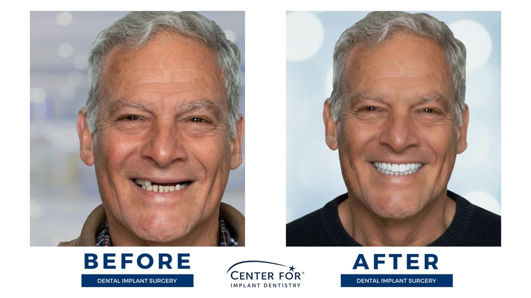 Full-arch dental implant smile result photo 2