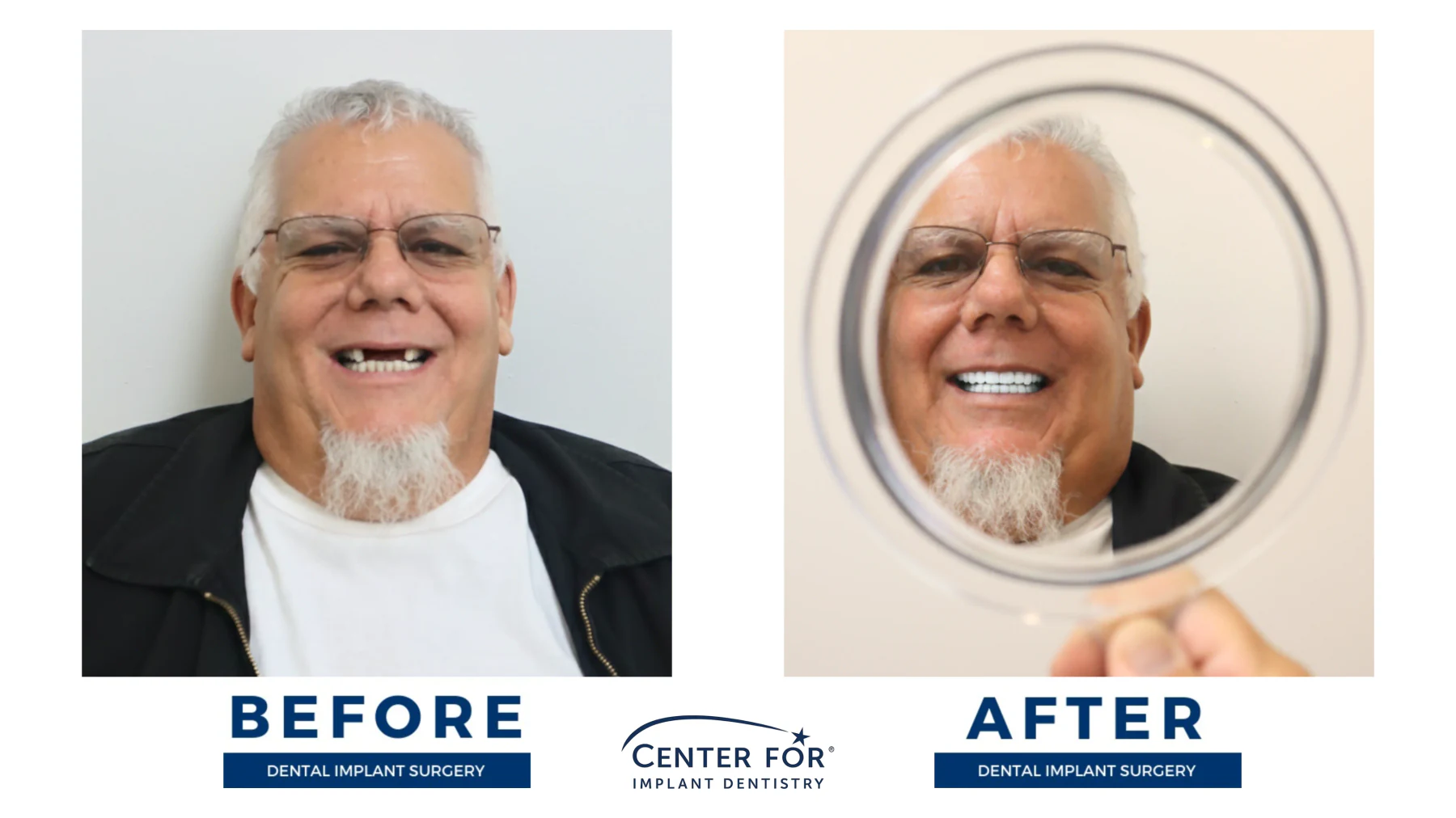 Full-arch dental implant smile result photo 3