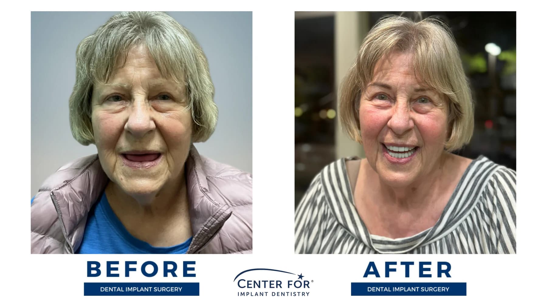 Full-arch dental implant smile result photo 4