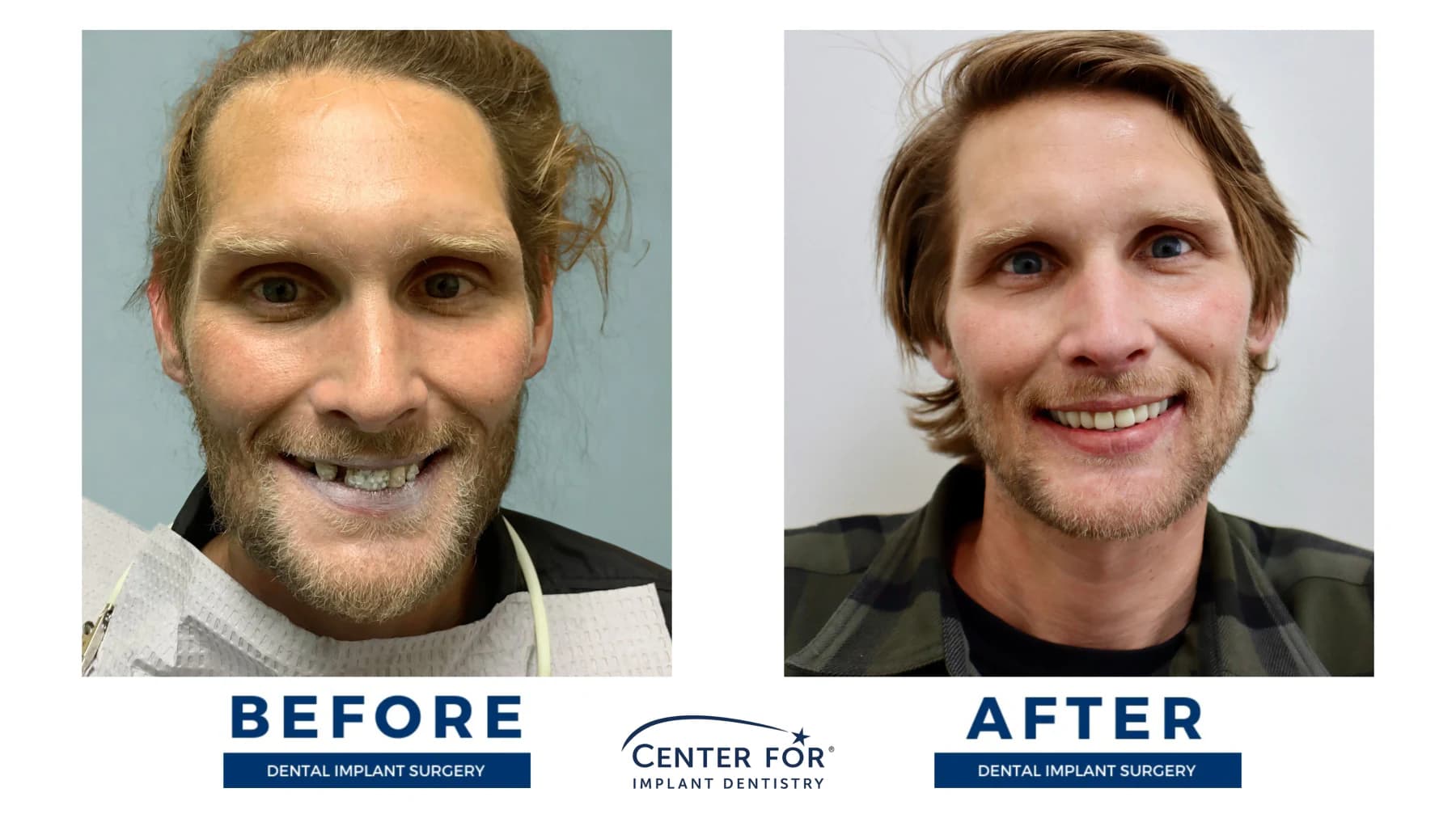 Full-arch dental implant smile result photo 5