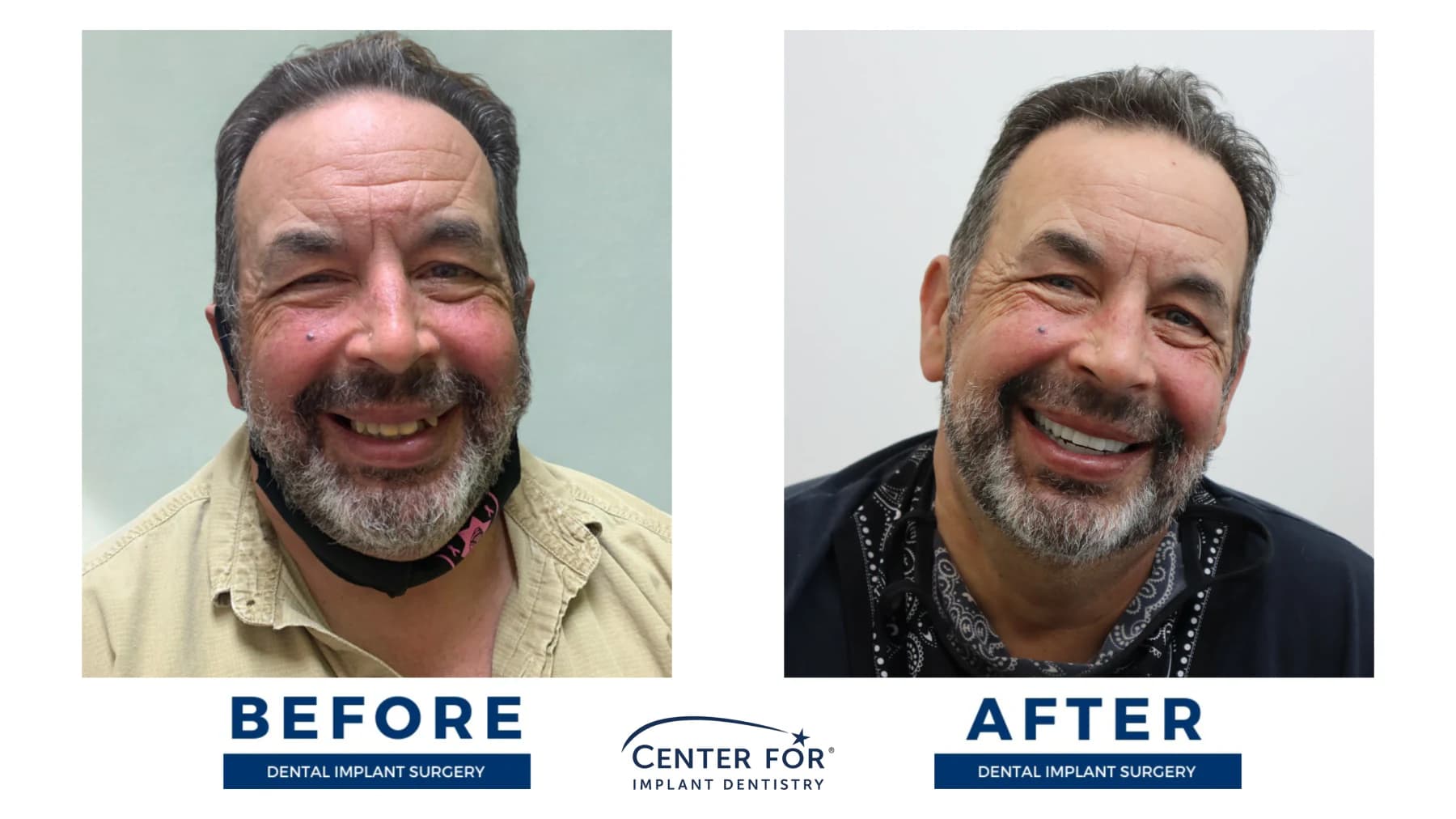 Full-arch dental implant smile result photo 6