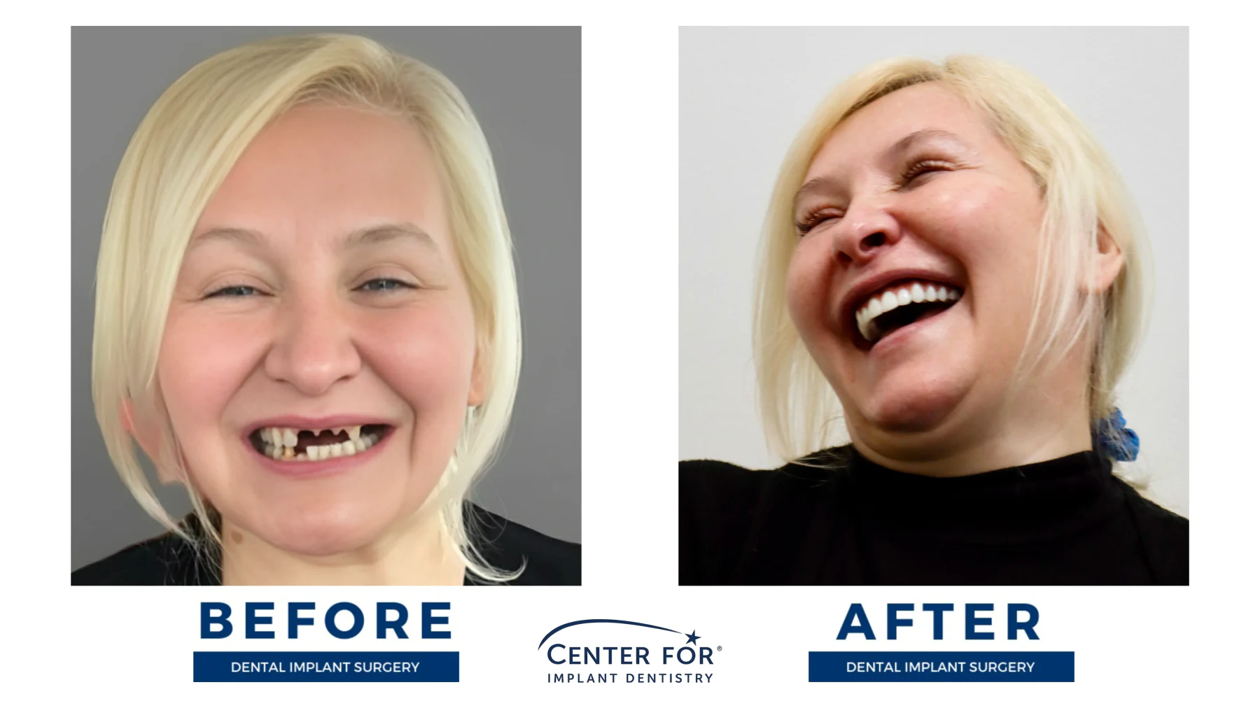 Full-arch dental implant smile result photo 7