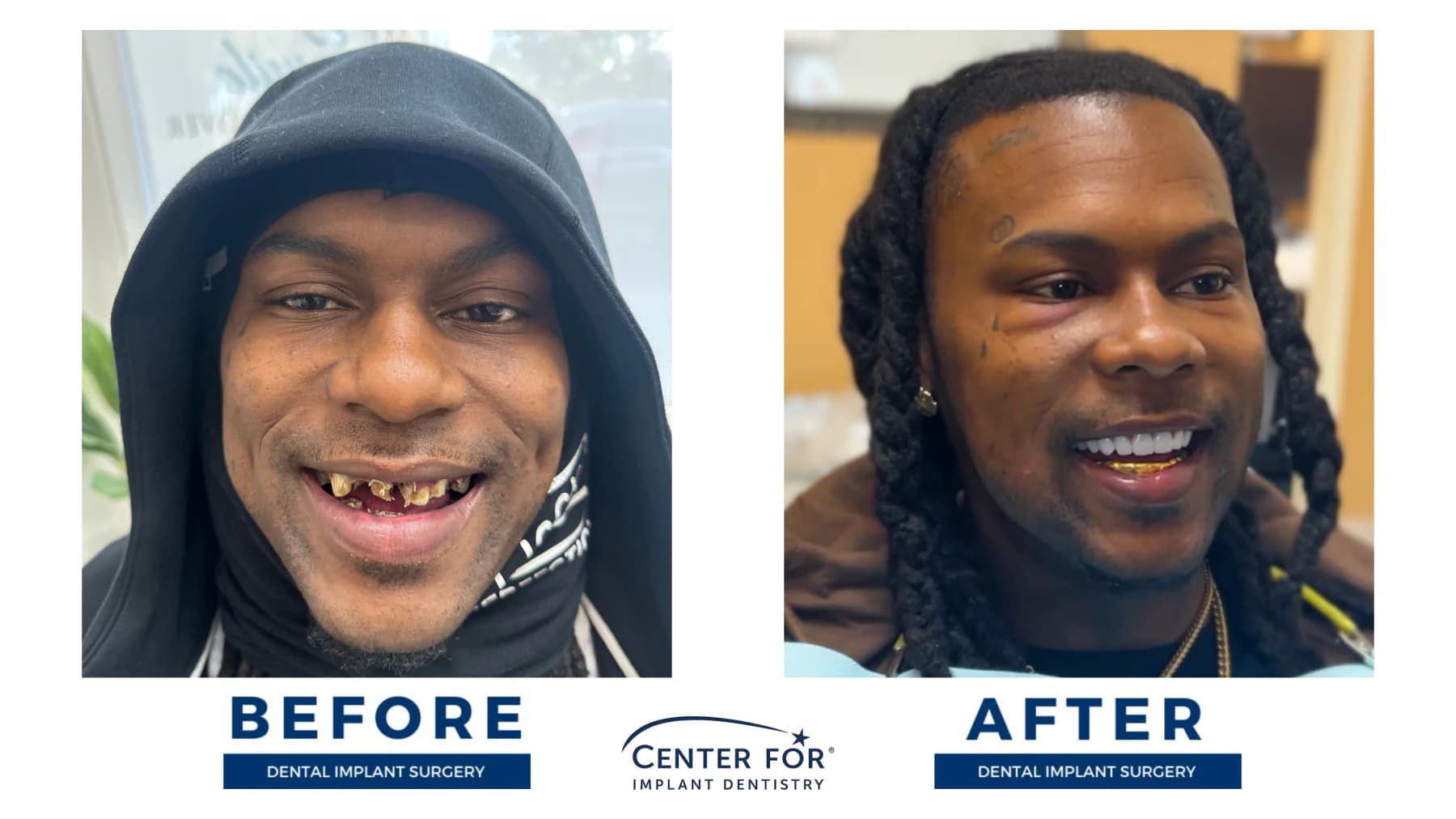 Full-arch dental implant smile result photo 8