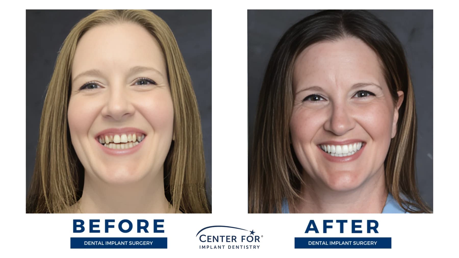Full-arch dental implant smile result photo 9