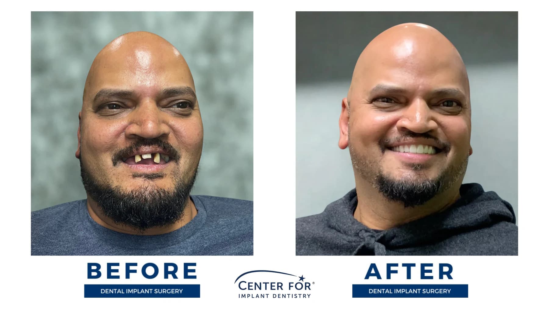 Full-arch dental implant smile result photo 10