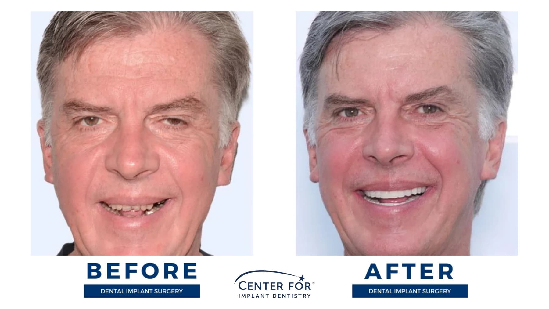 Full-arch dental implant smile result photo 11