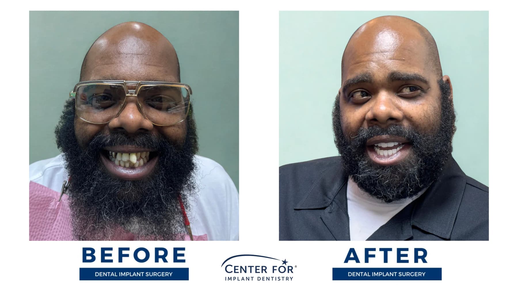 Full-arch dental implant smile result photo 12