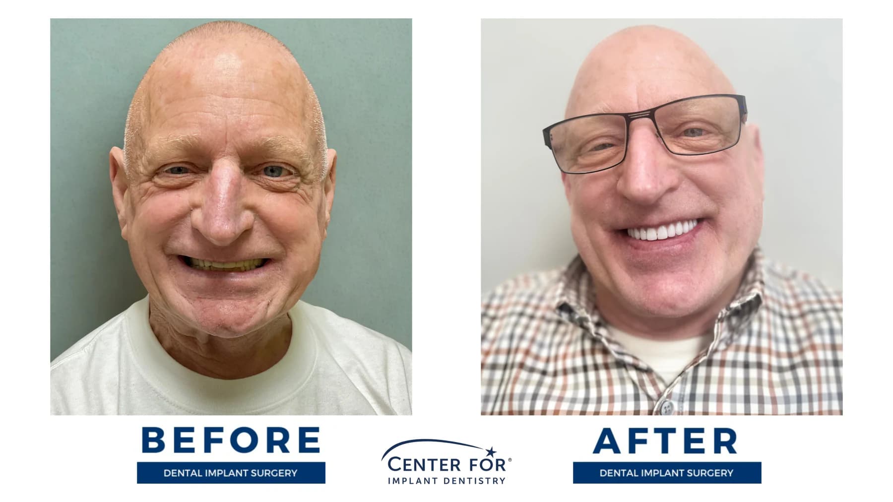 Full-arch dental implant smile result photo 13