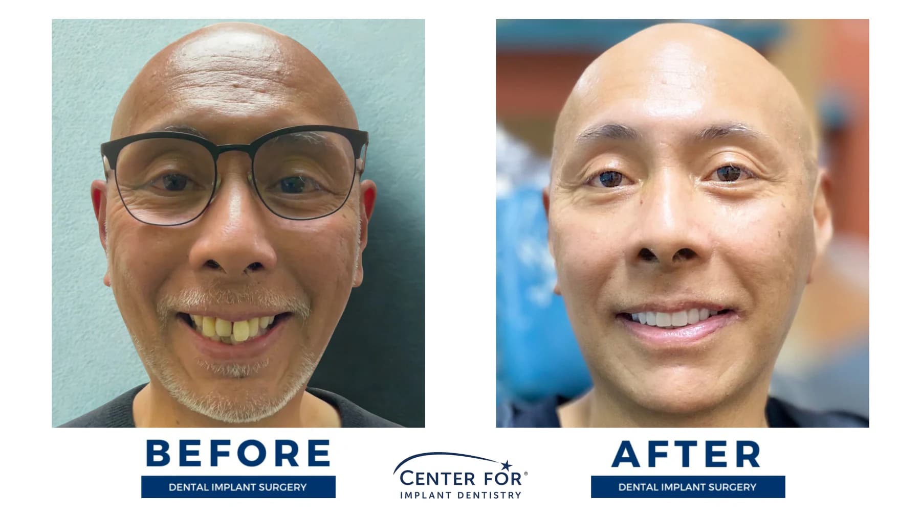 Full-arch dental implant smile result photo 14