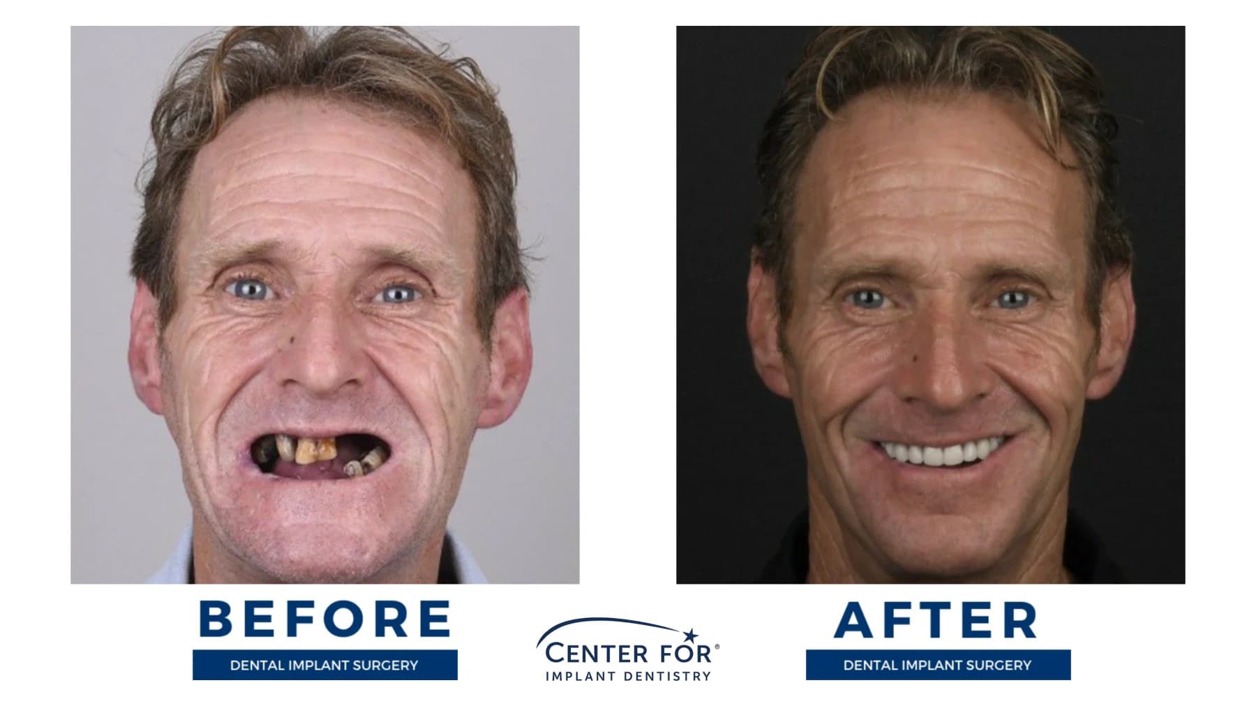 Full-arch dental implant smile result photo 15