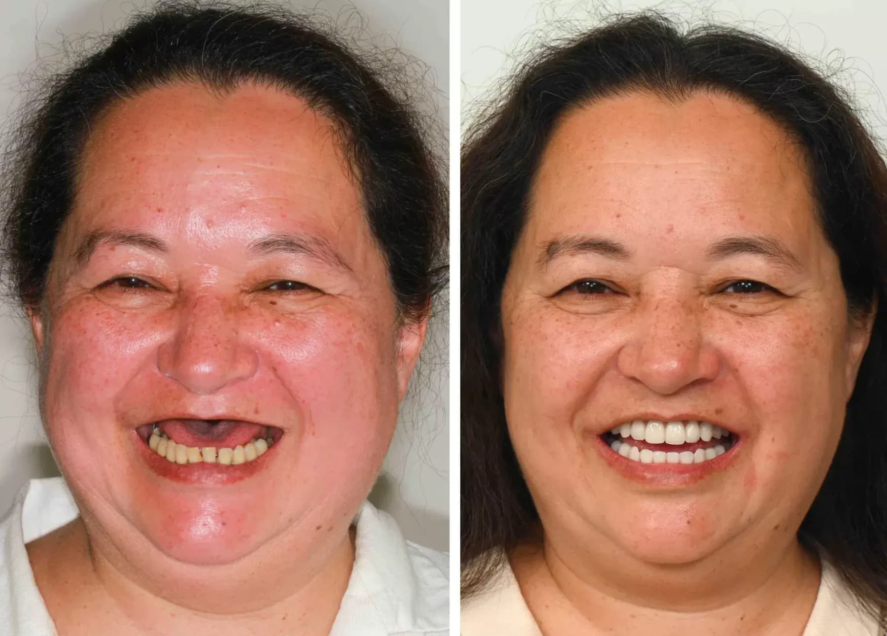 "The cost of dental implants seemed overwhelming until I found this office. They offered transparent financing and the results are worth every penny. No more glue, no more plastic palate."