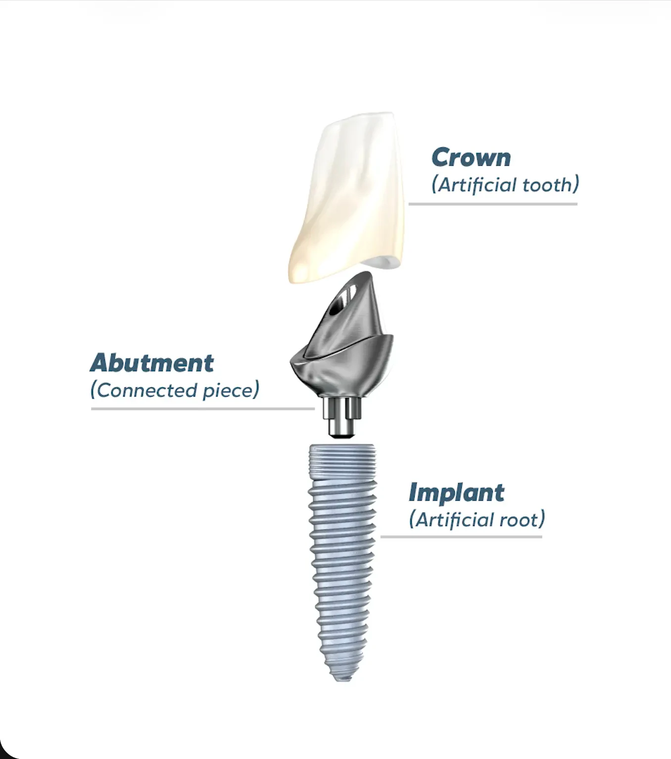 Diagram of the components of full mouth dental implants