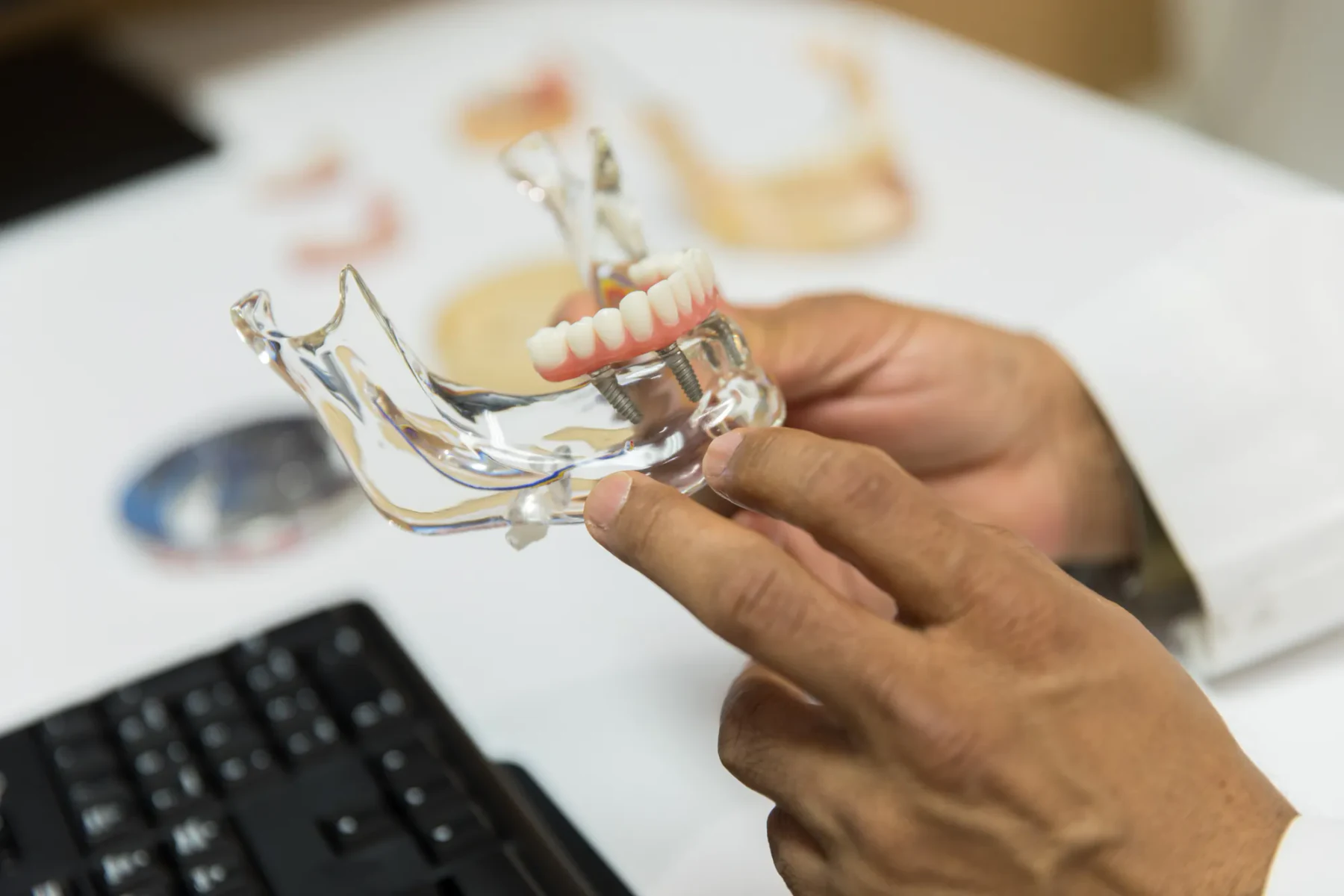 Dental implant model showing four implants supporting a full arch of teeth