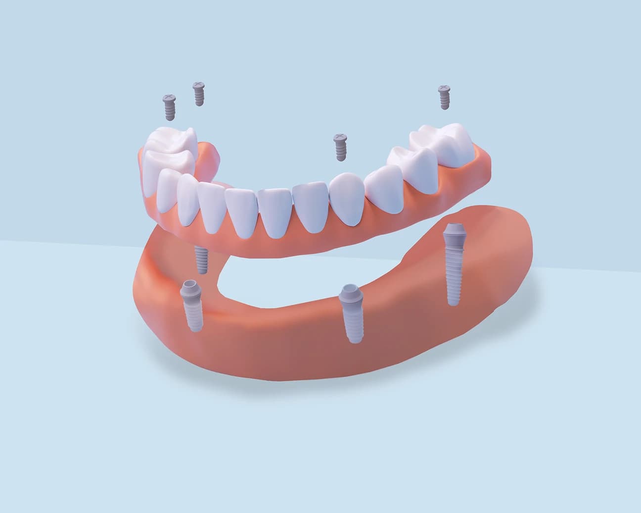 All-on-4 full arch dental implant restoration at Center for Implant Dentistry in Fremont