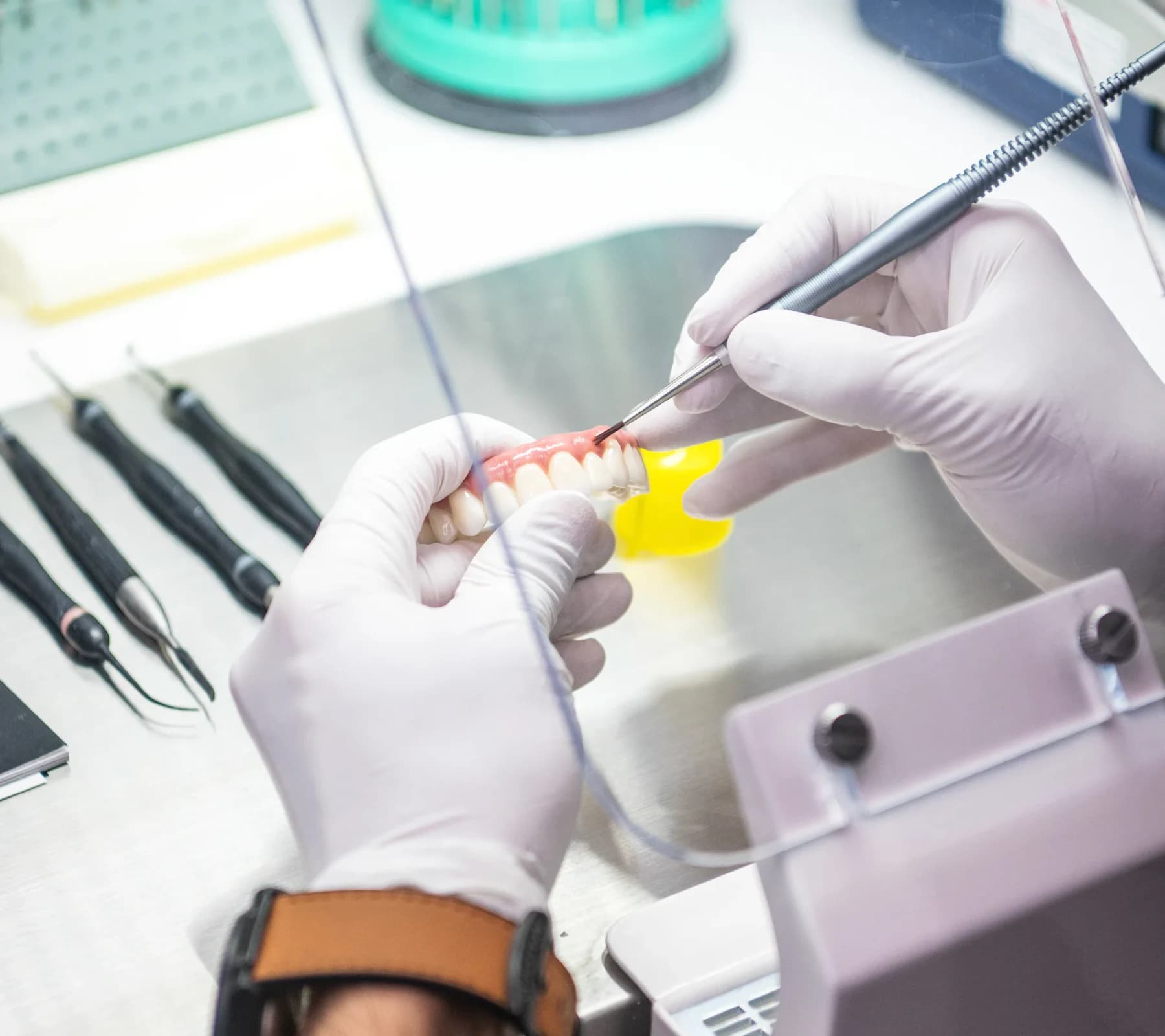 Full-arch implant bridge used in permanent smile restoration