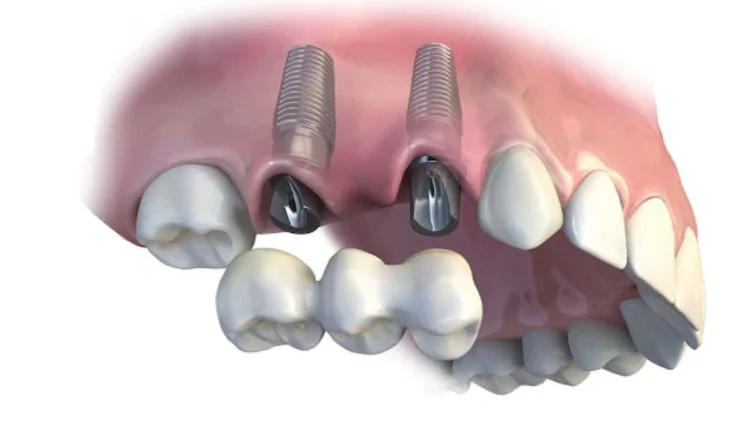 Multiple dental implant supported bridge replacing several missing teeth with affordable Bay Area pricing