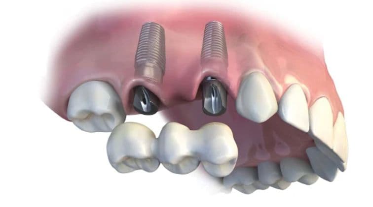 Implant Bridge (Multiple Teeth)