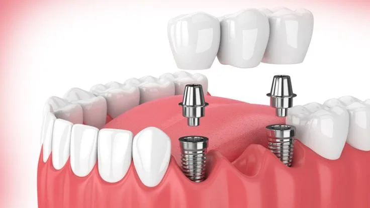 Multiple dental implants supporting a fixed zirconia bridge