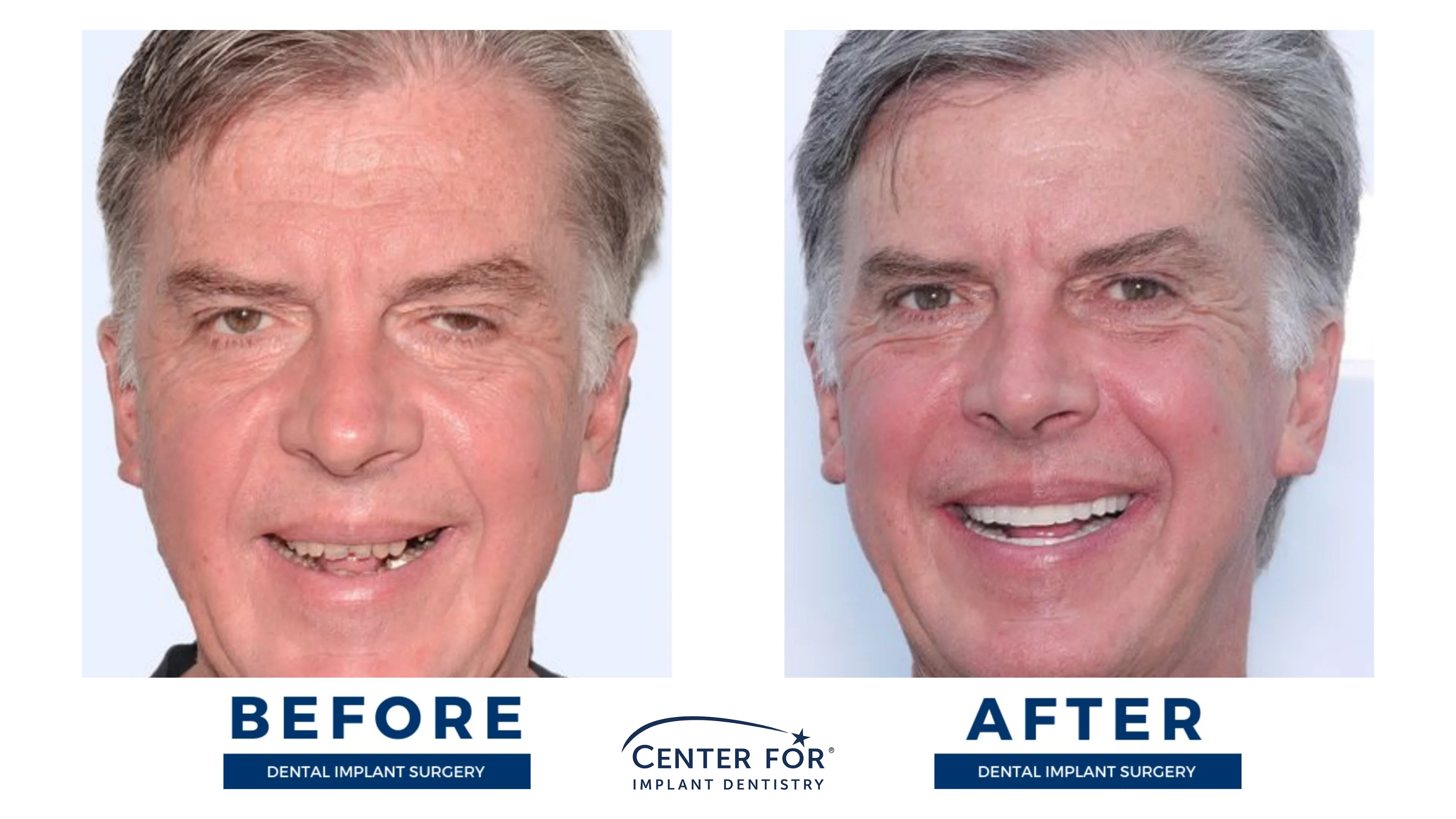 Before-and-after dental implant smile gallery case 11