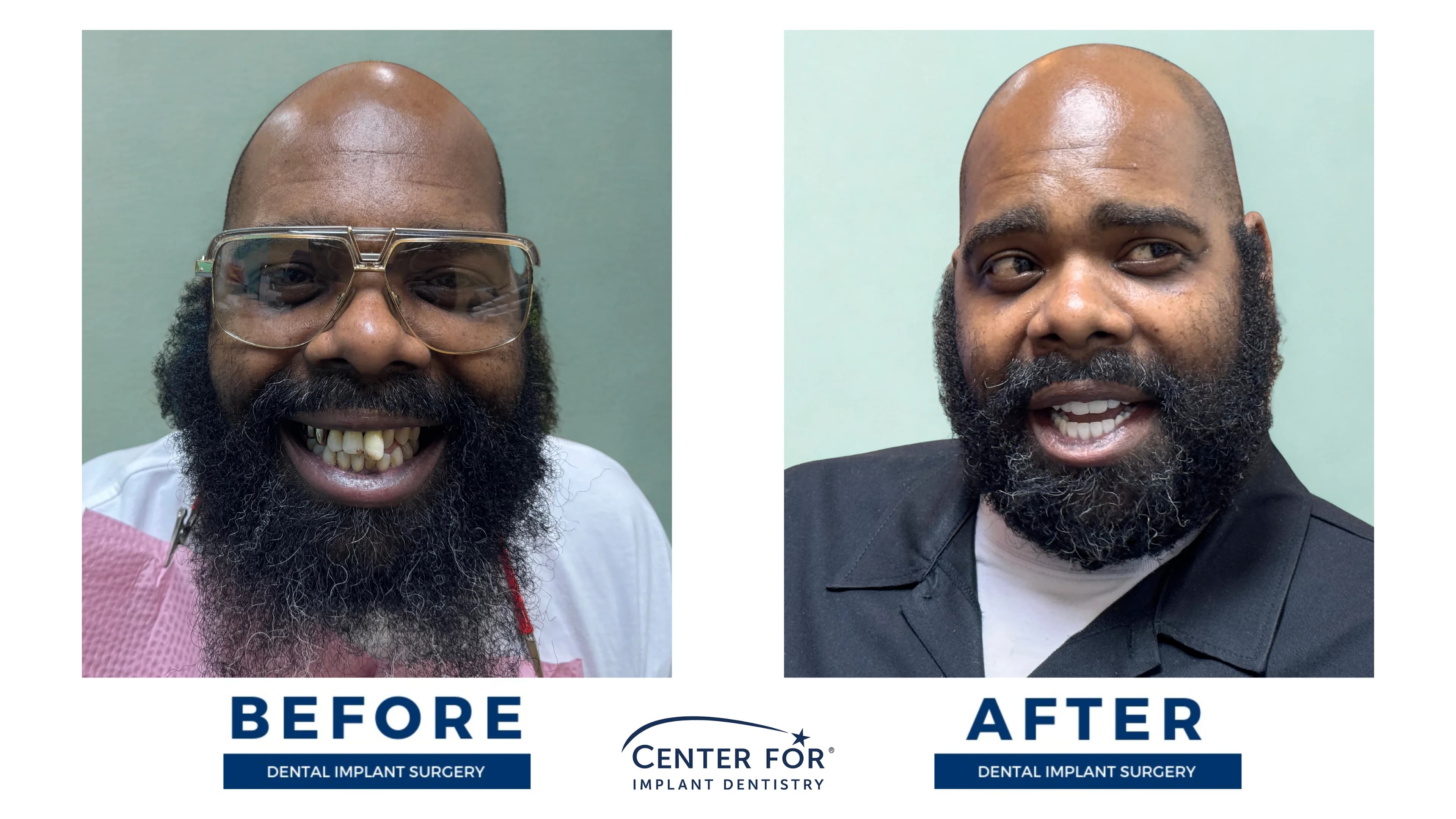 Before-and-after dental implant smile gallery case 12
