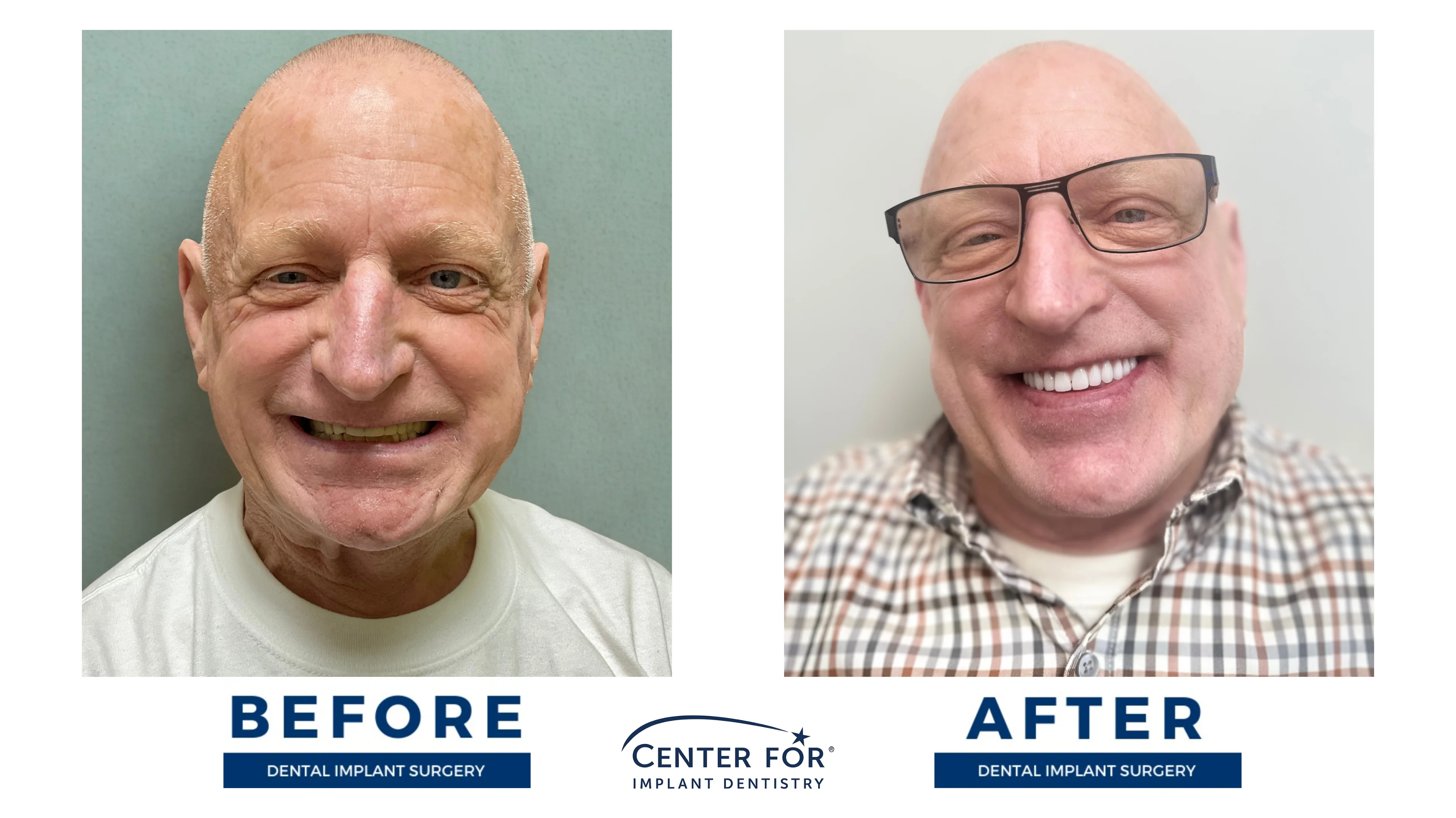 Before-and-after dental implant smile gallery case 13