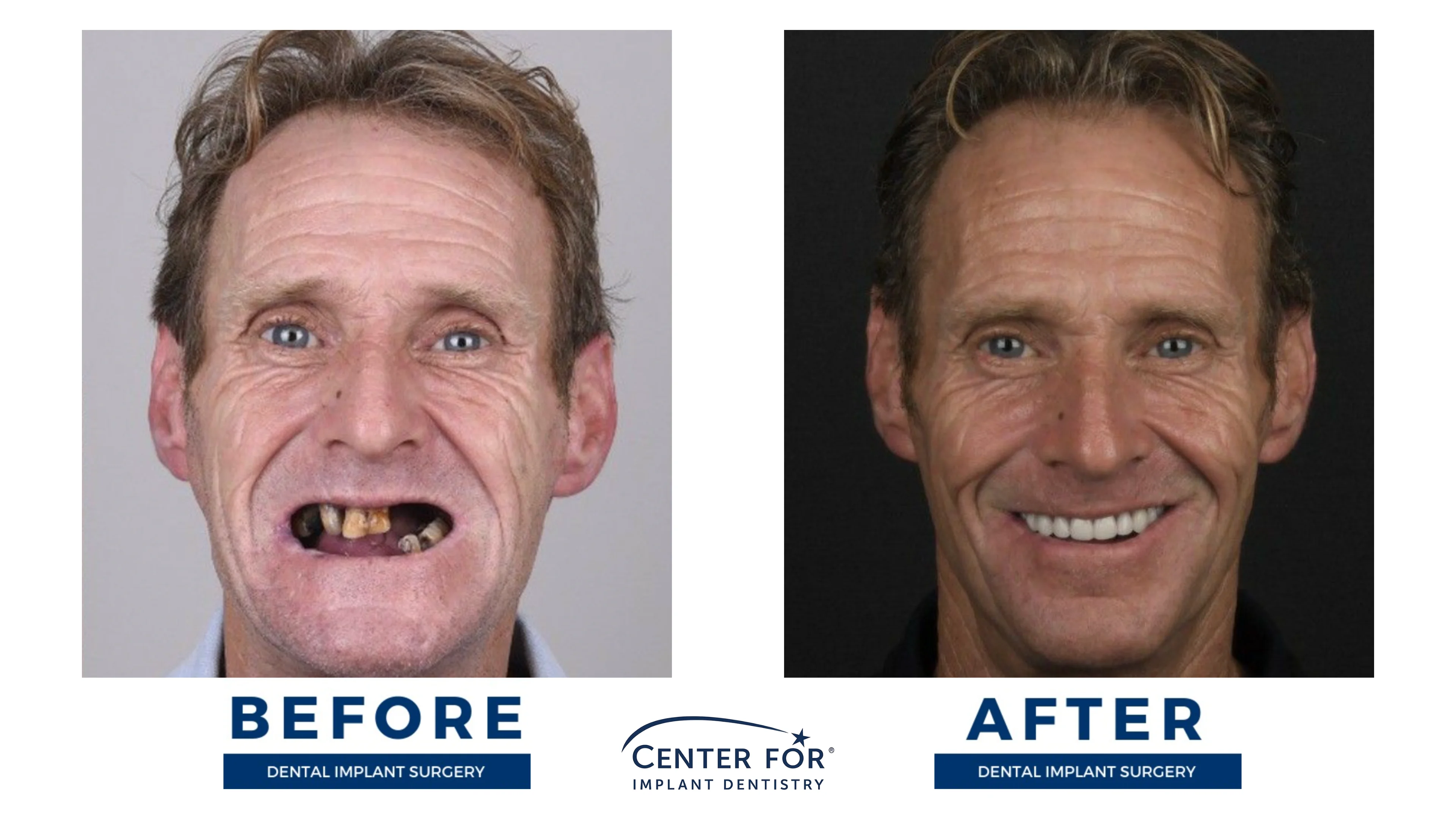 Before-and-after dental implant smile gallery case 15