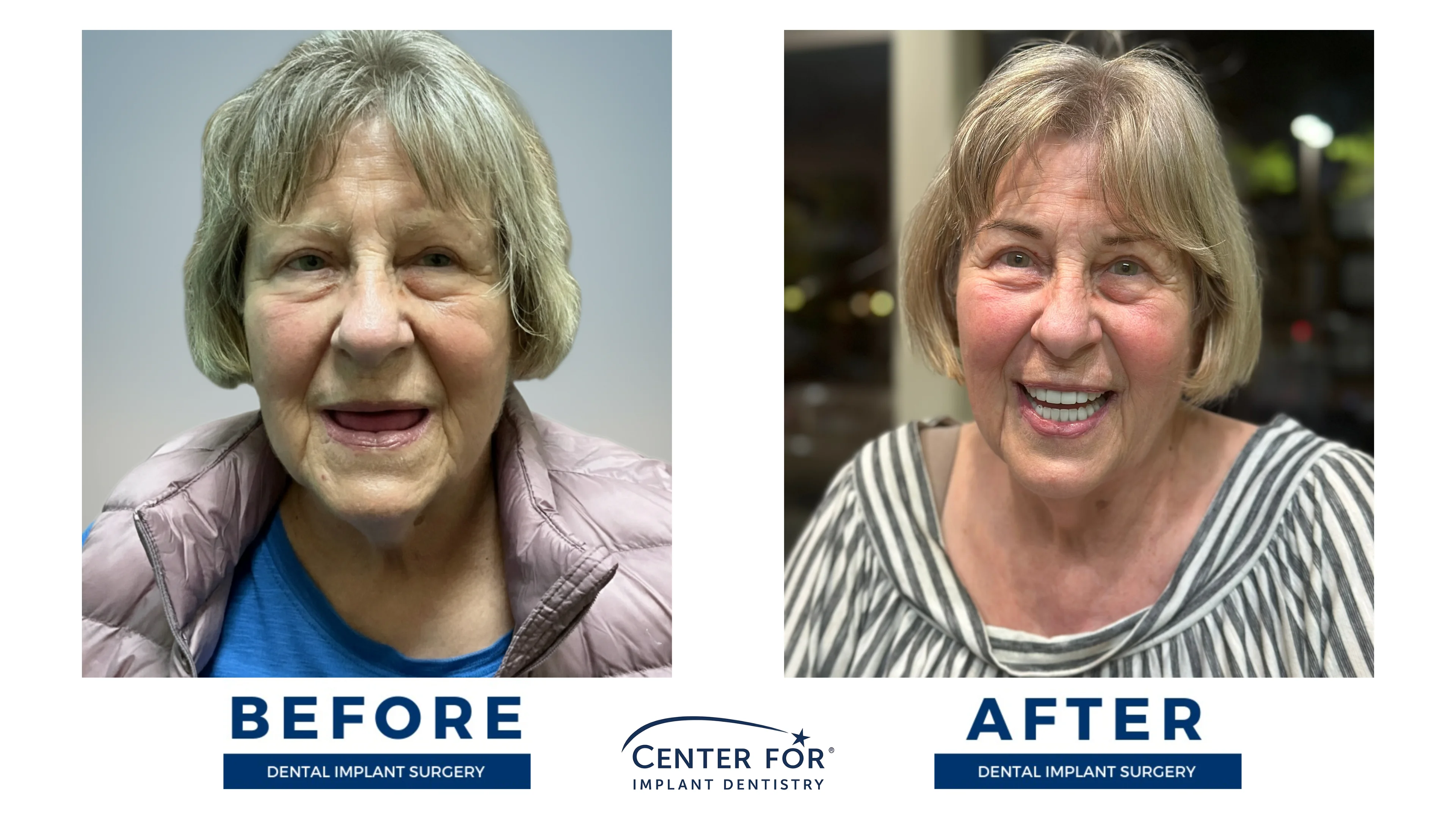 Before-and-after dental implant smile gallery case 4