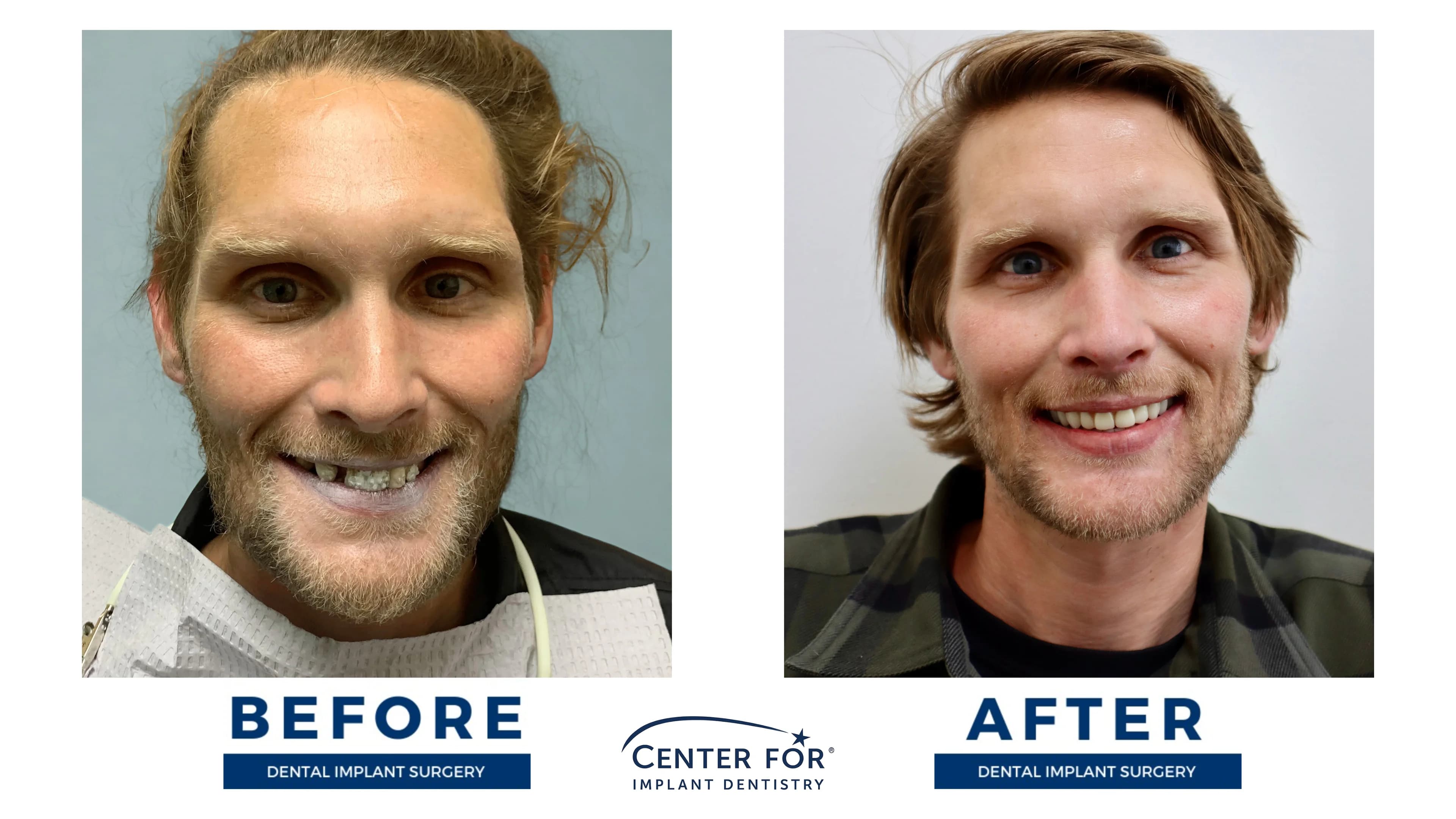 Before-and-after dental implant smile gallery case 5