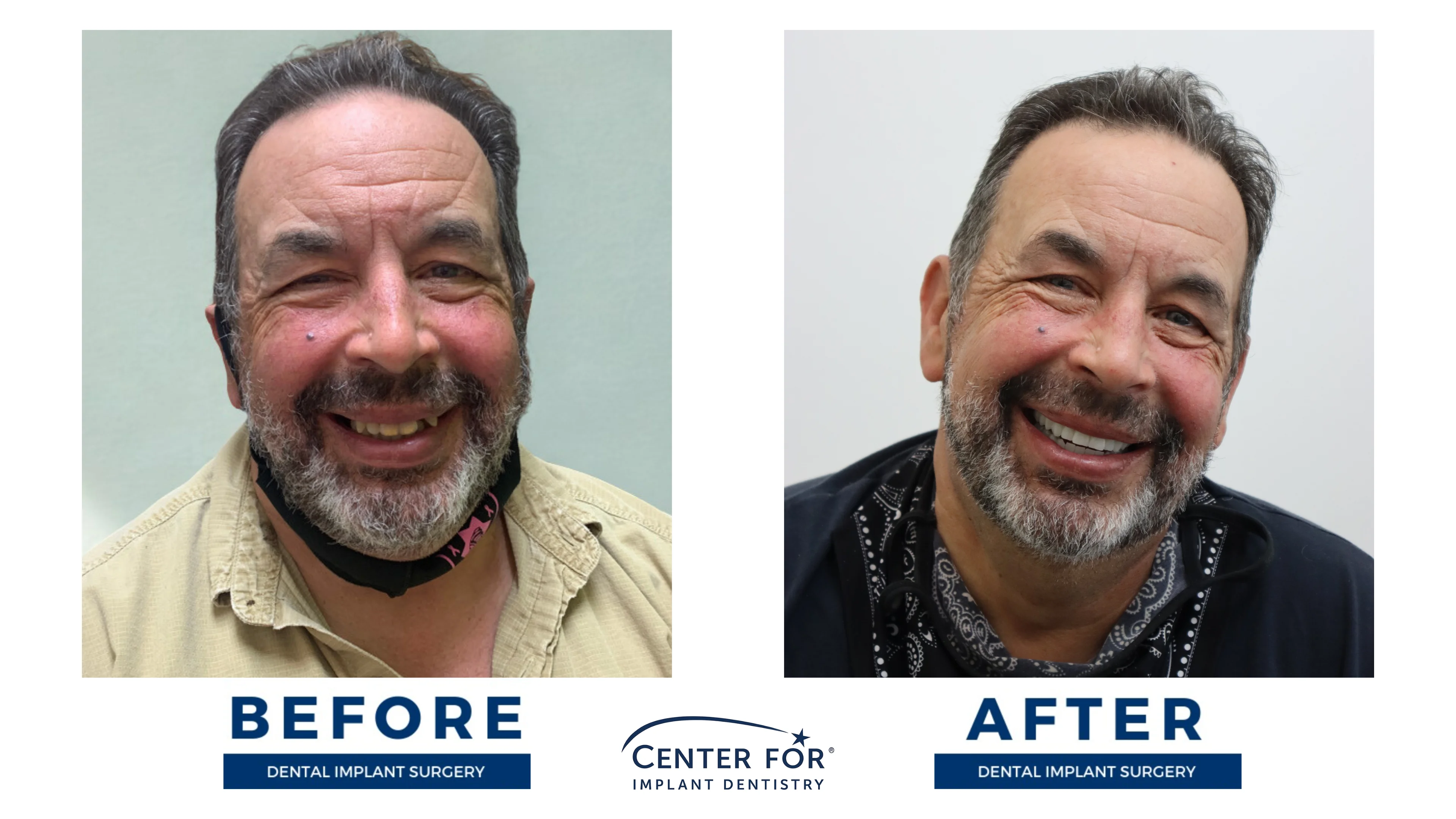 Before-and-after dental implant smile gallery case 6