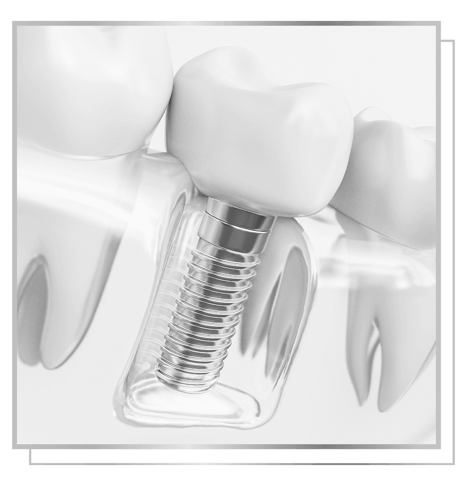 Single Tooth Implant