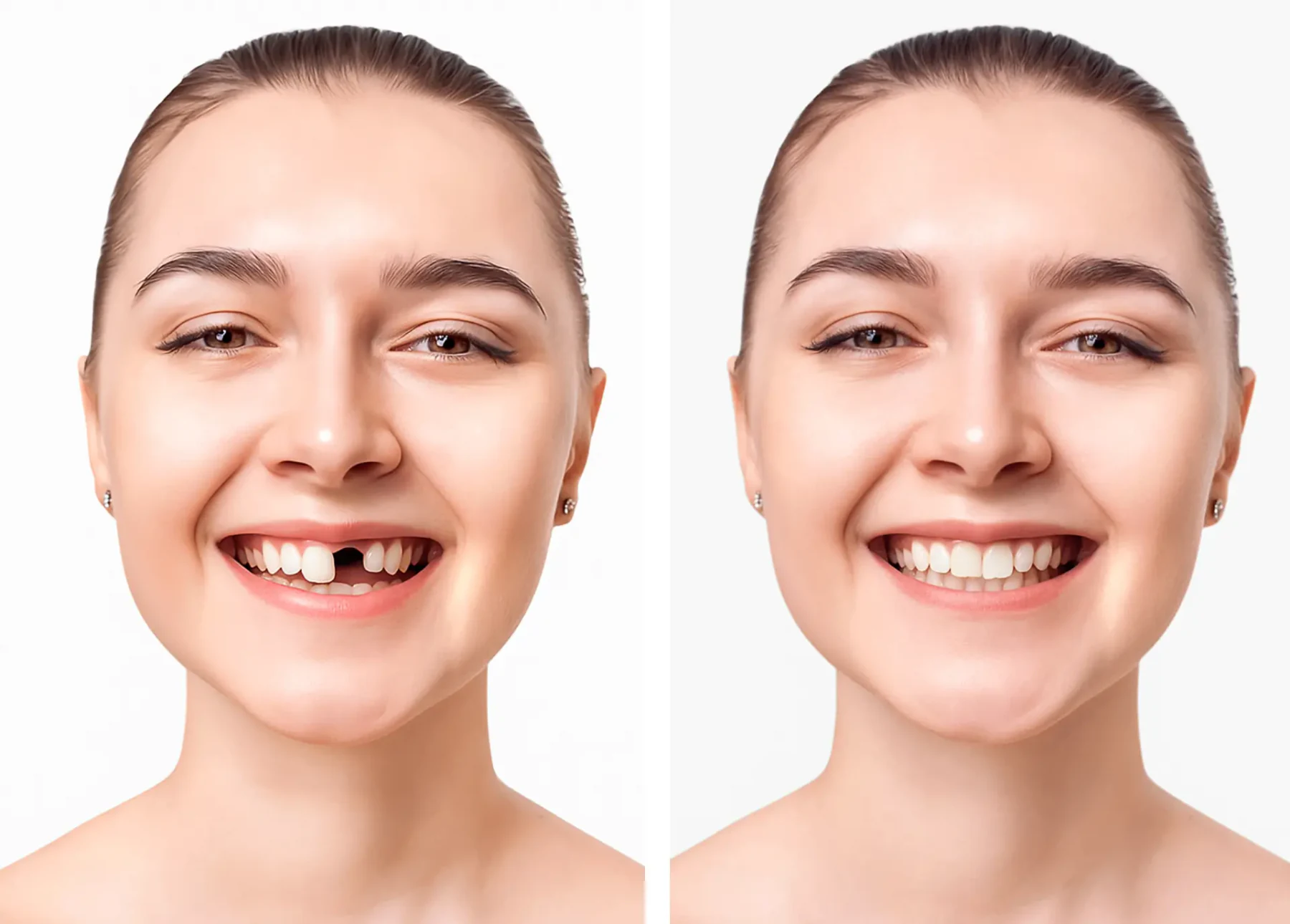 Before-and-after result of a single dental implant and crown replacement