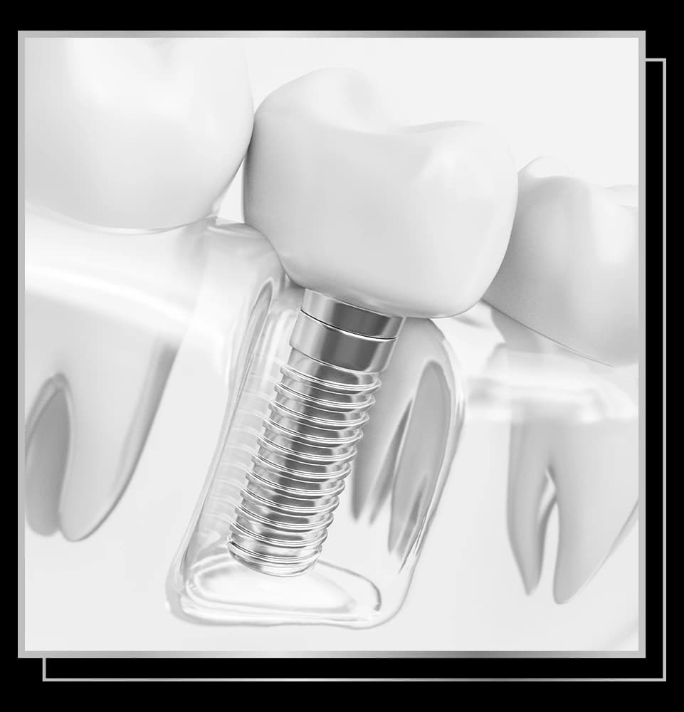 Illustration of a single tooth implant with implant, abutment, and crown