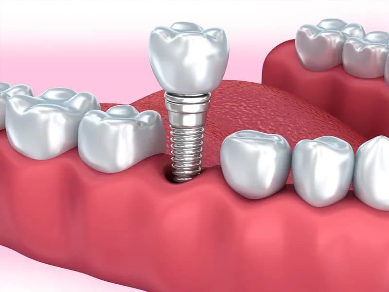 Single tooth dental implant with abutment and zirconia crown