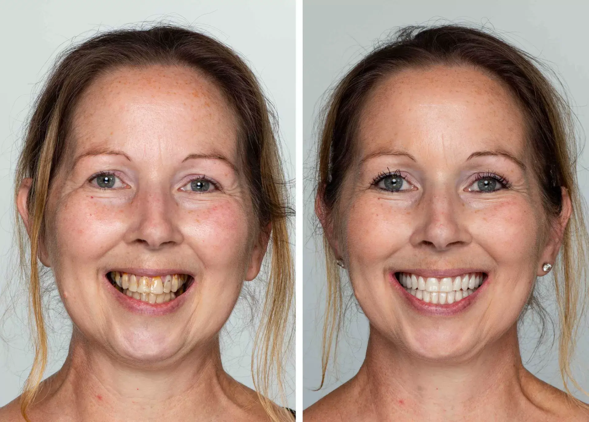 "I searched for 'best dental implant services near me' and found Dr. Jain. For 15 years, I couldn't eat. Today, with my Zirconia implants, I can bite into an apple and laugh without worry."