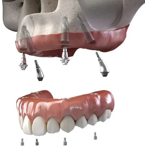 Quad-Cortical Anchorage: The Zygomatic Solution