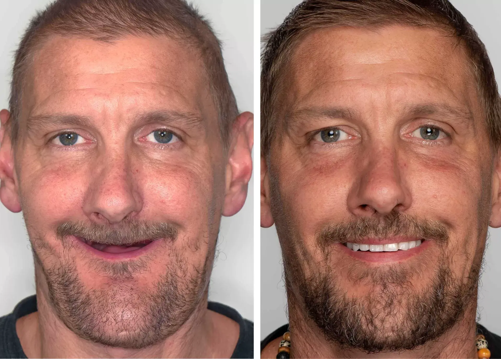 David K. after dental implant treatment