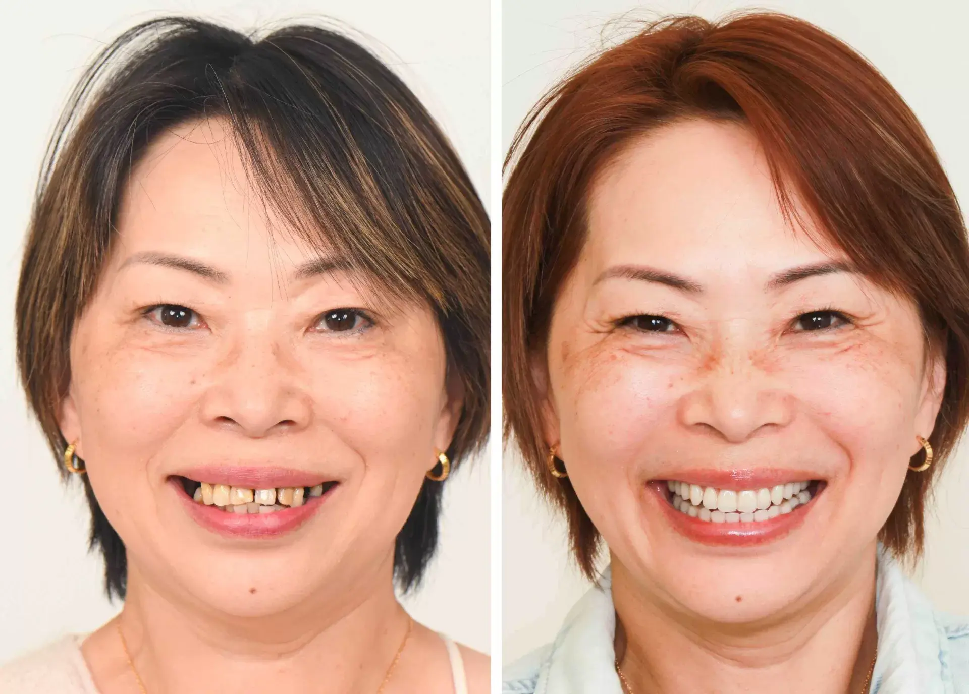 Patricia L. after Multiple Teeth Implant + Crown at Center for Implant Dentistry in Fremont, CA — dental implants with abutment and crown.